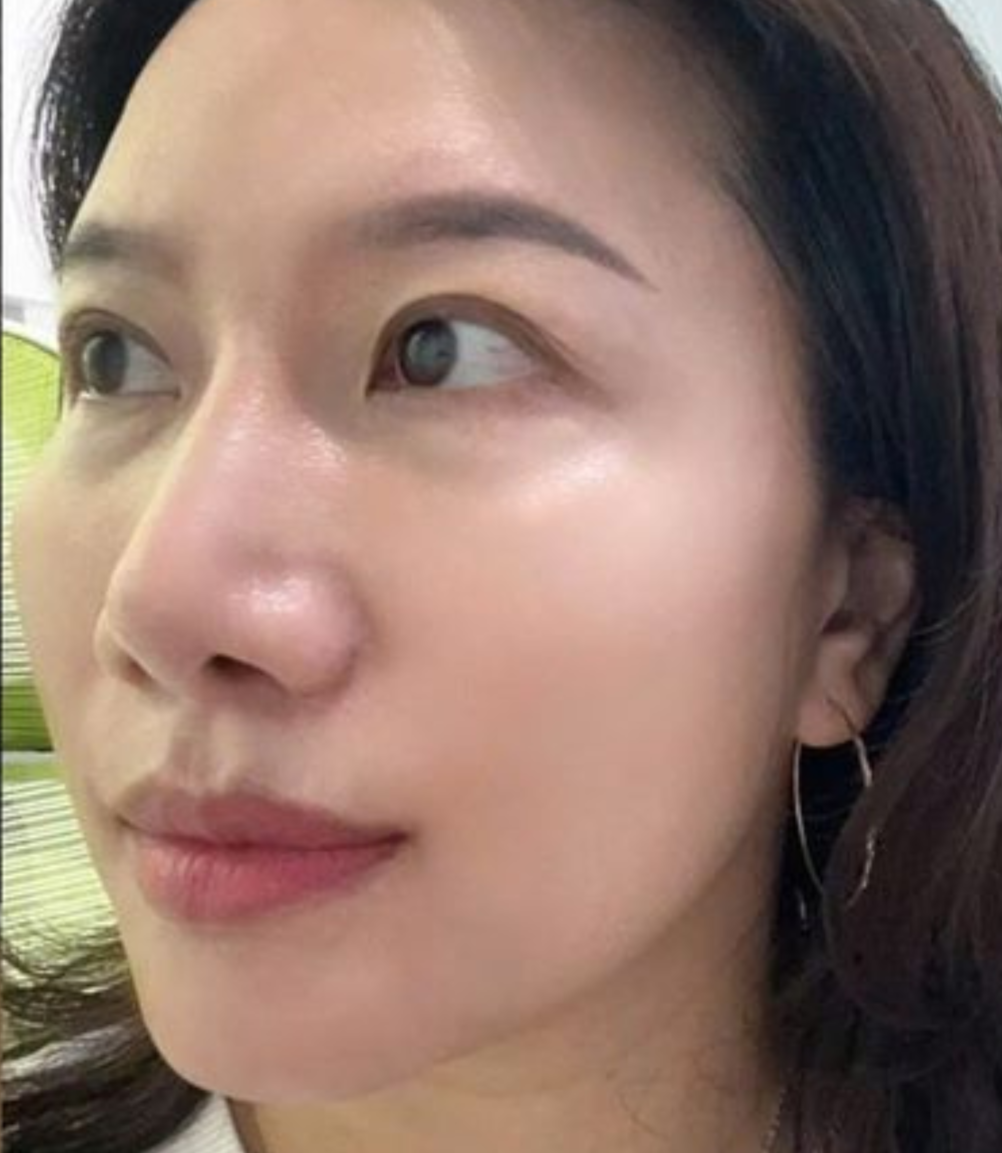 Cánh mũi to thô không hài hòa với gương mặt
