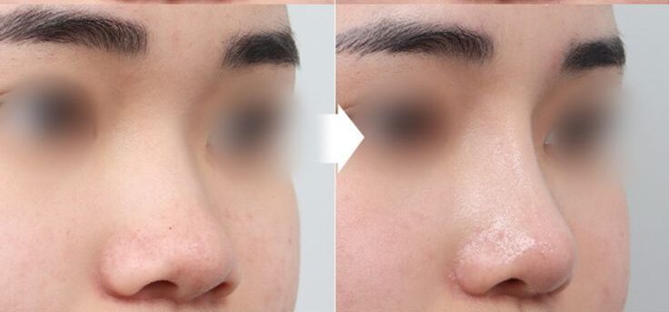 Thu gọn đầu mũi ở Dencos Luxury