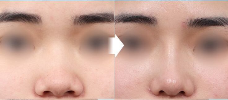 Thu gọn đầu mũi ở Dencos Luxury