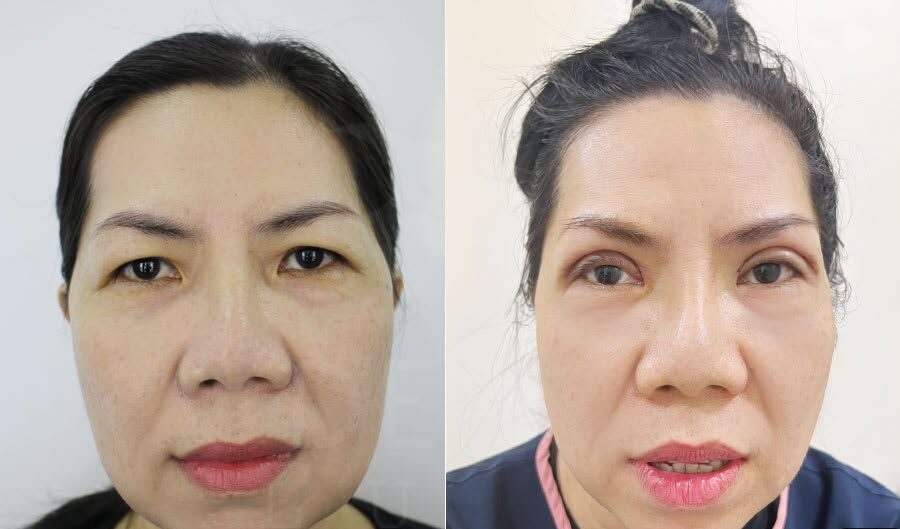 Sụp mí do thừa cơ mi ở người già