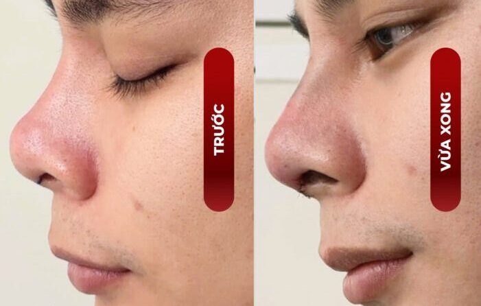 Phẩu thuật nâng mũi sụn nhân tạo