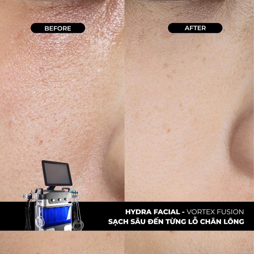 Hydra Facial tại Dencos Luxury