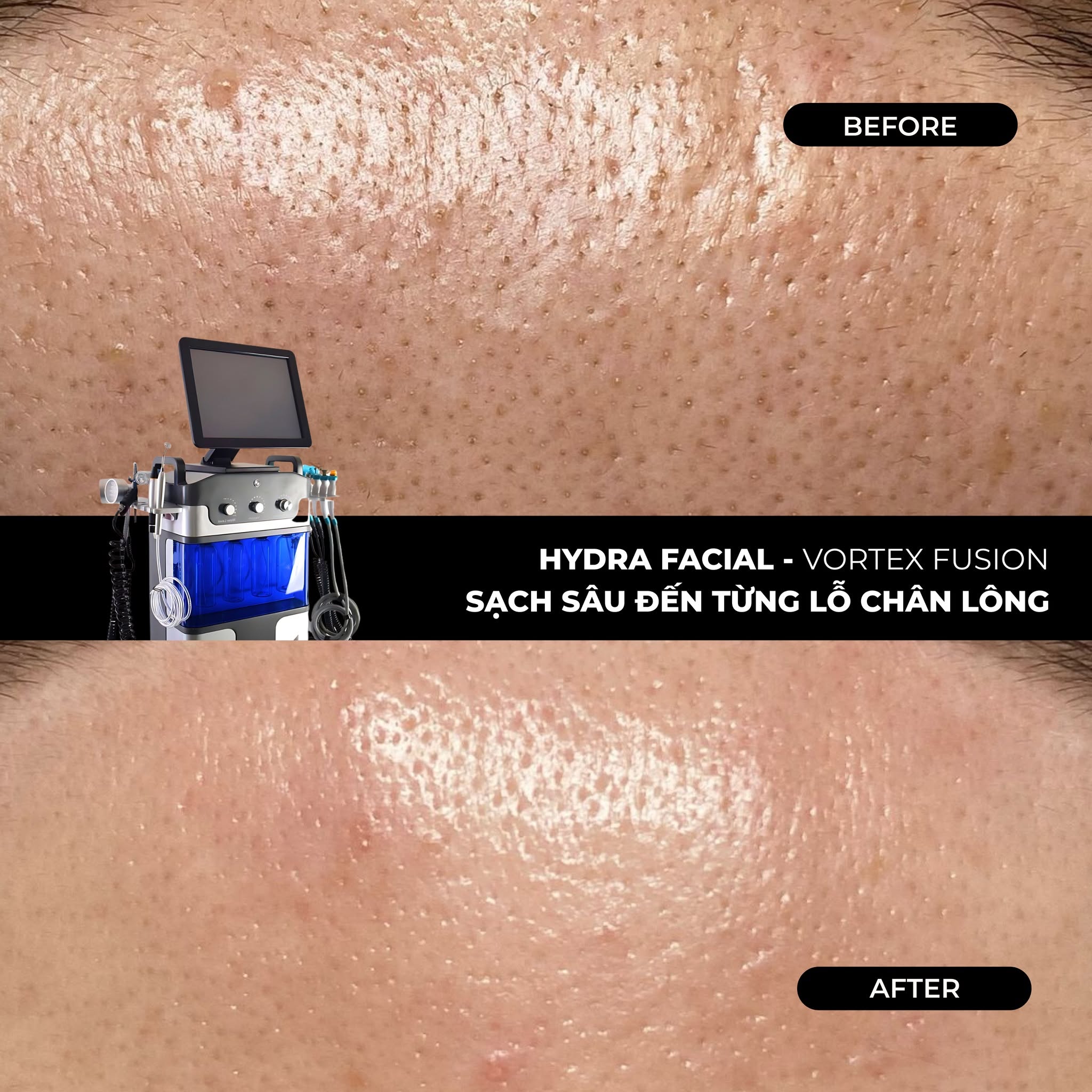 Hydral Facial