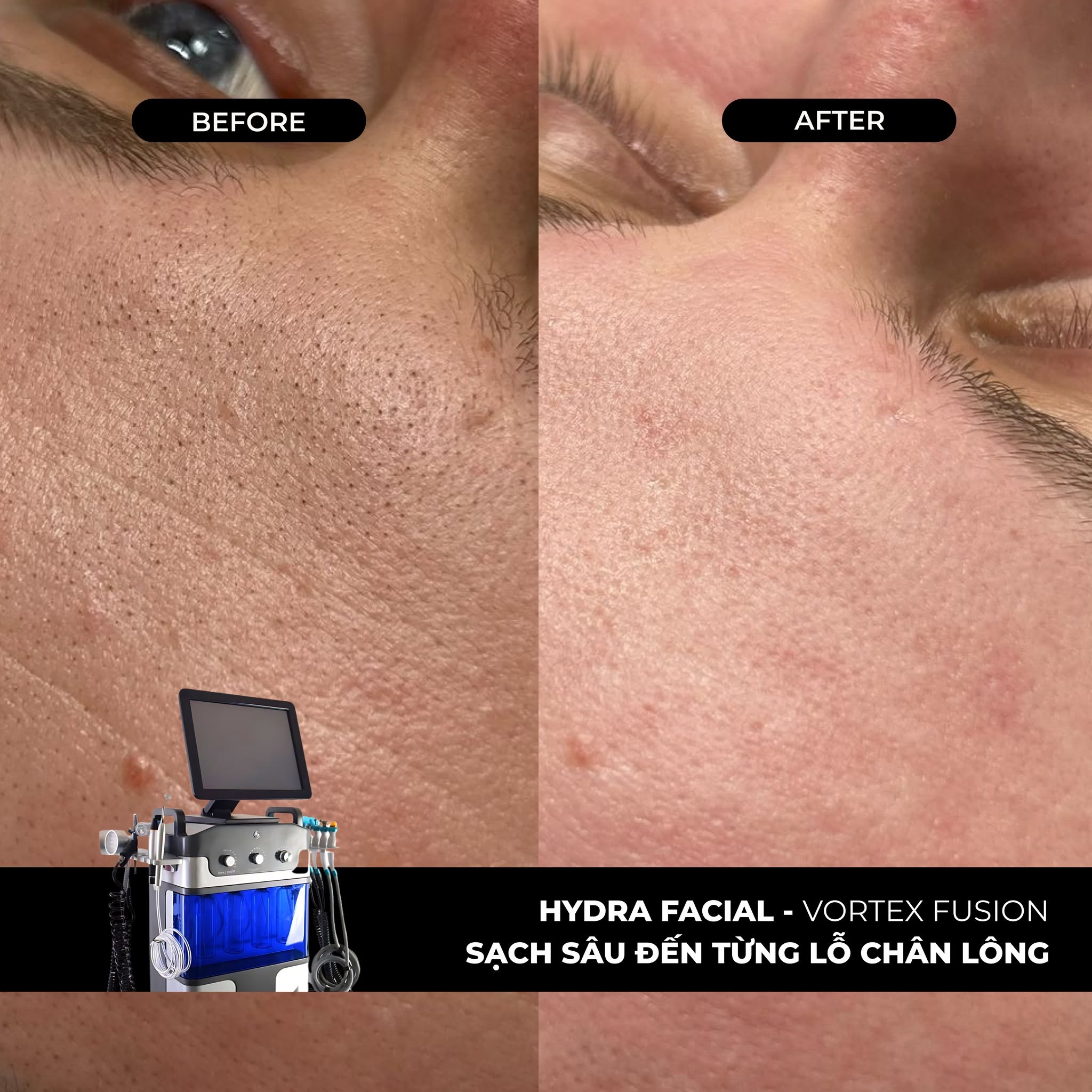 Hydra Facial tại Dencos Luxury