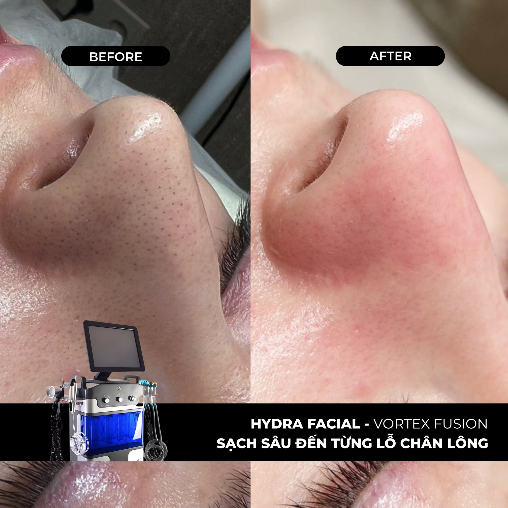 Hydrafacial tại Dencos Luxury