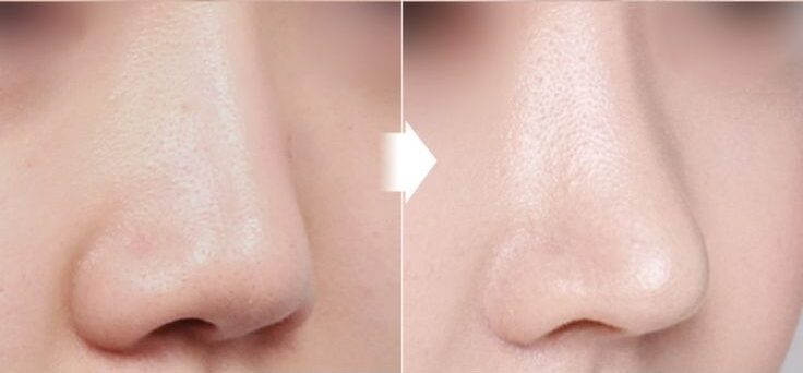 Nâng mũi sụn tại Dencos Luxury