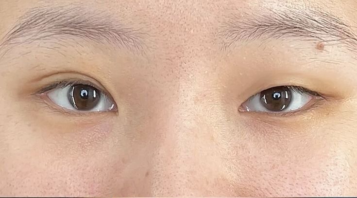 phẩu thuật sụp mí mắt