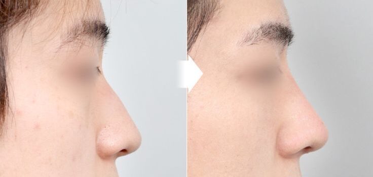 Nâng mũi sụn tại Dencos Luxury