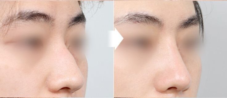 Nâng mũi sụn tại Dencos Luxury