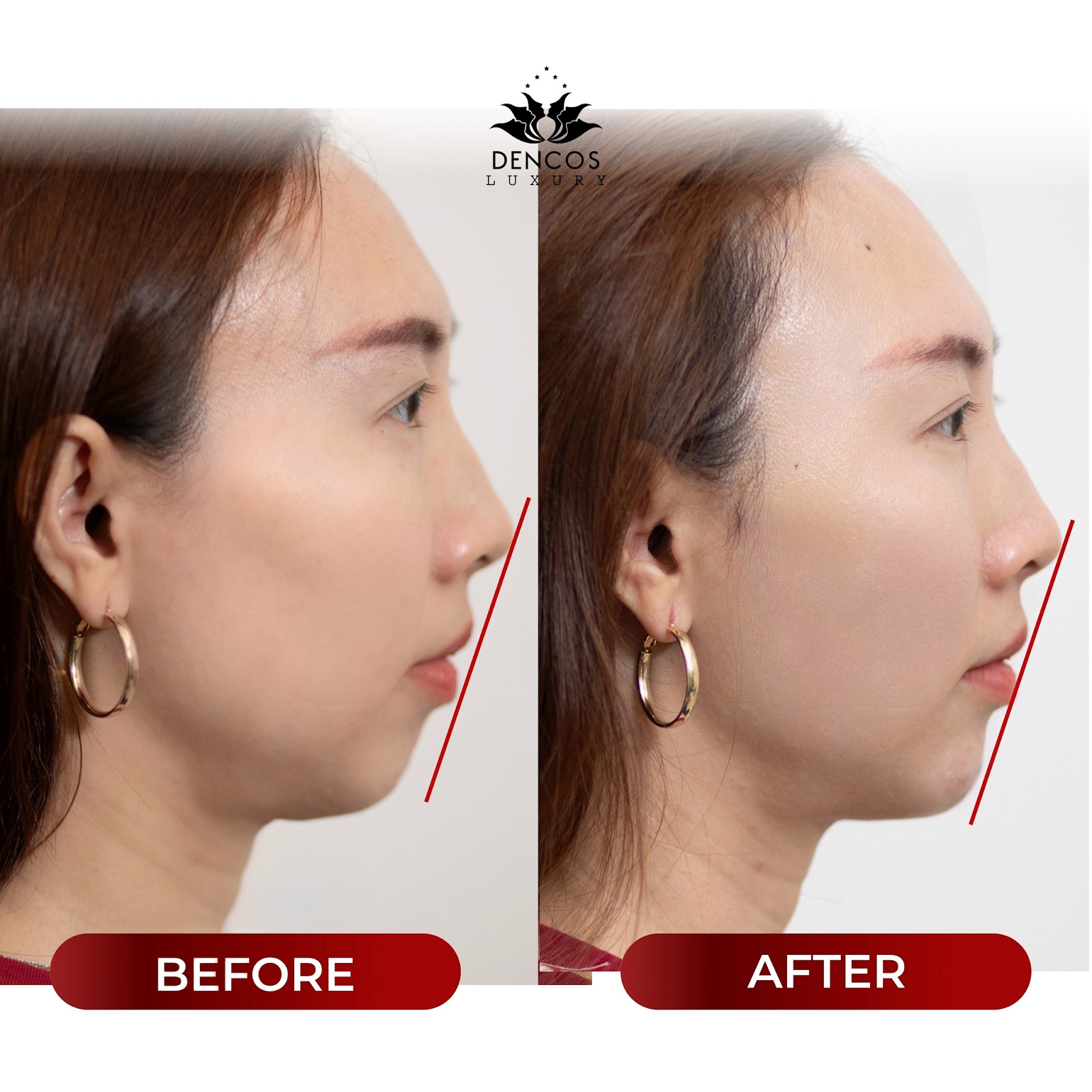 Vampire Facelift – Không dừng ở cân chỉnh tỷ lệ cằm ở Dencos Luxury