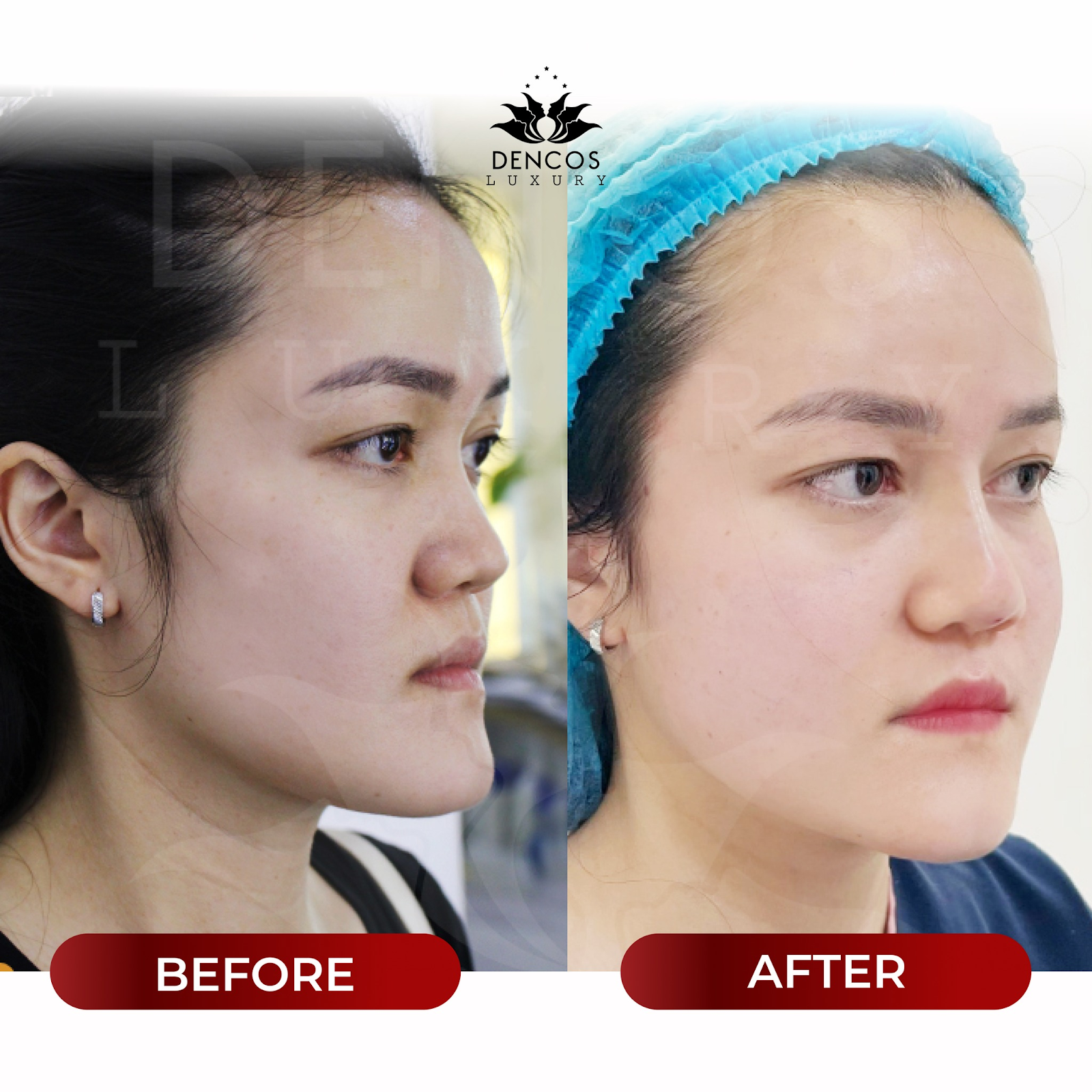 Vampire Facelift – Không dừng ở cân chỉnh tỷ lệ cằm ở Dencos Luxury