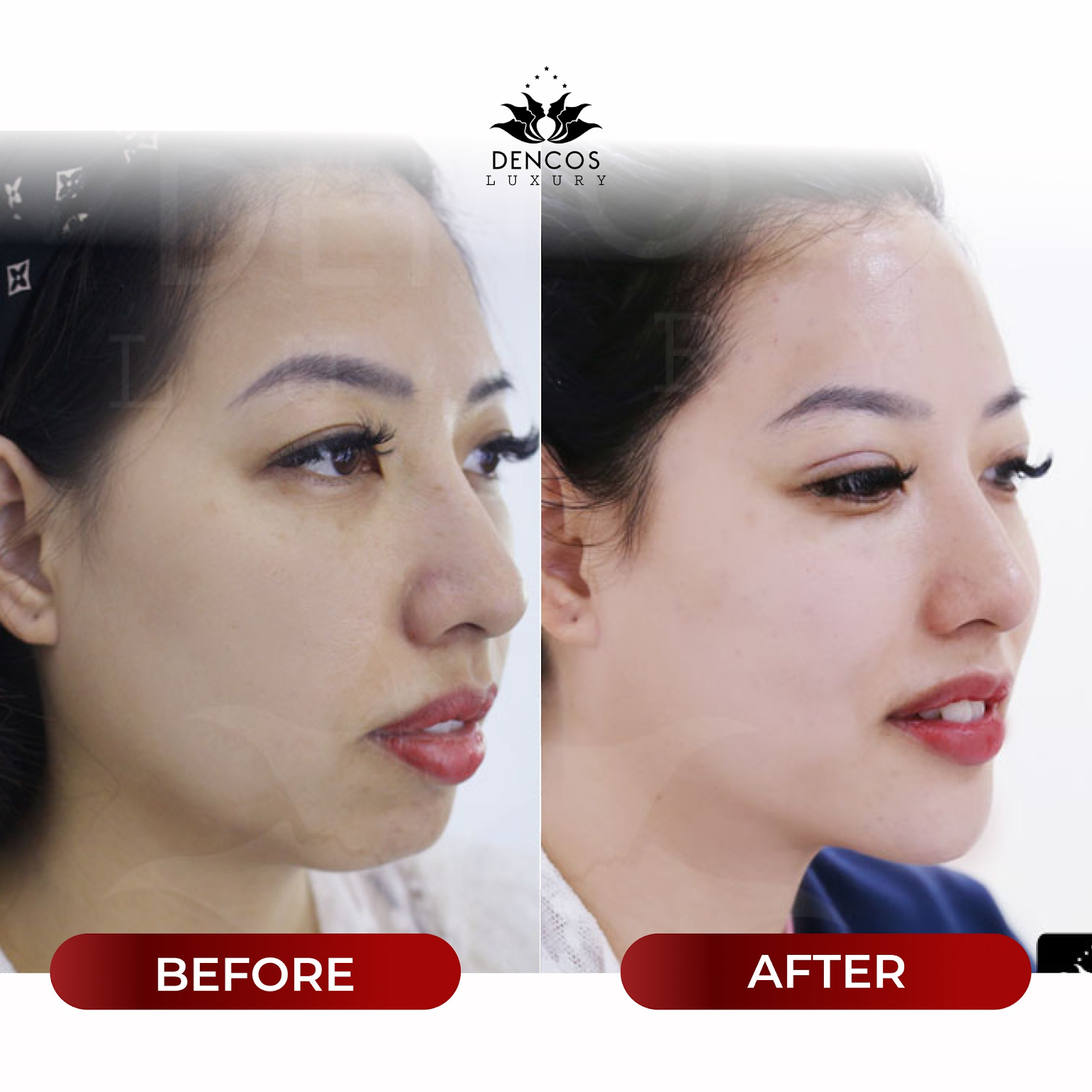 Vampire Facelift – Không dừng ở cân chỉnh tỷ lệ cằm ở Dencos Luxury