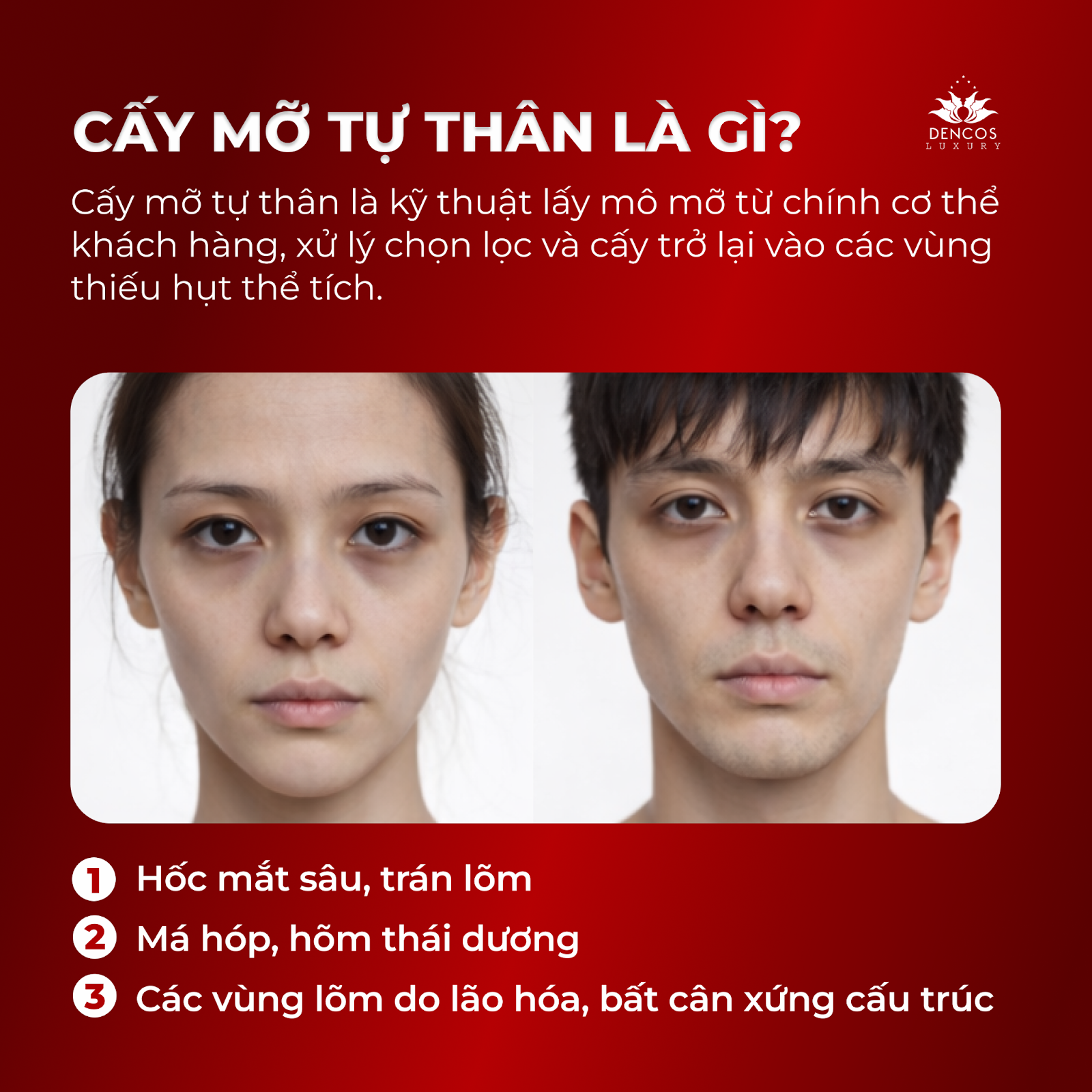 Cấy mỡ tự thân - Giải pháp xử lý triệt để trũng, hóp, mất cân đối gương mặt tại Dencos Luxury