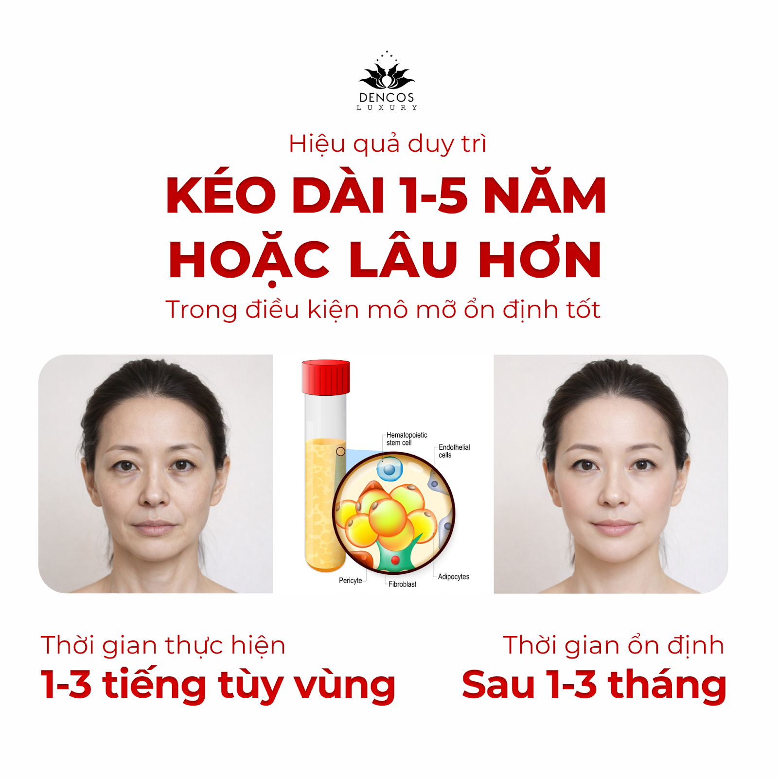 Cấy mỡ tự thân - Giải pháp xử lý triệt để trũng, hóp, mất cân đối gương mặt tại Dencos Luxury