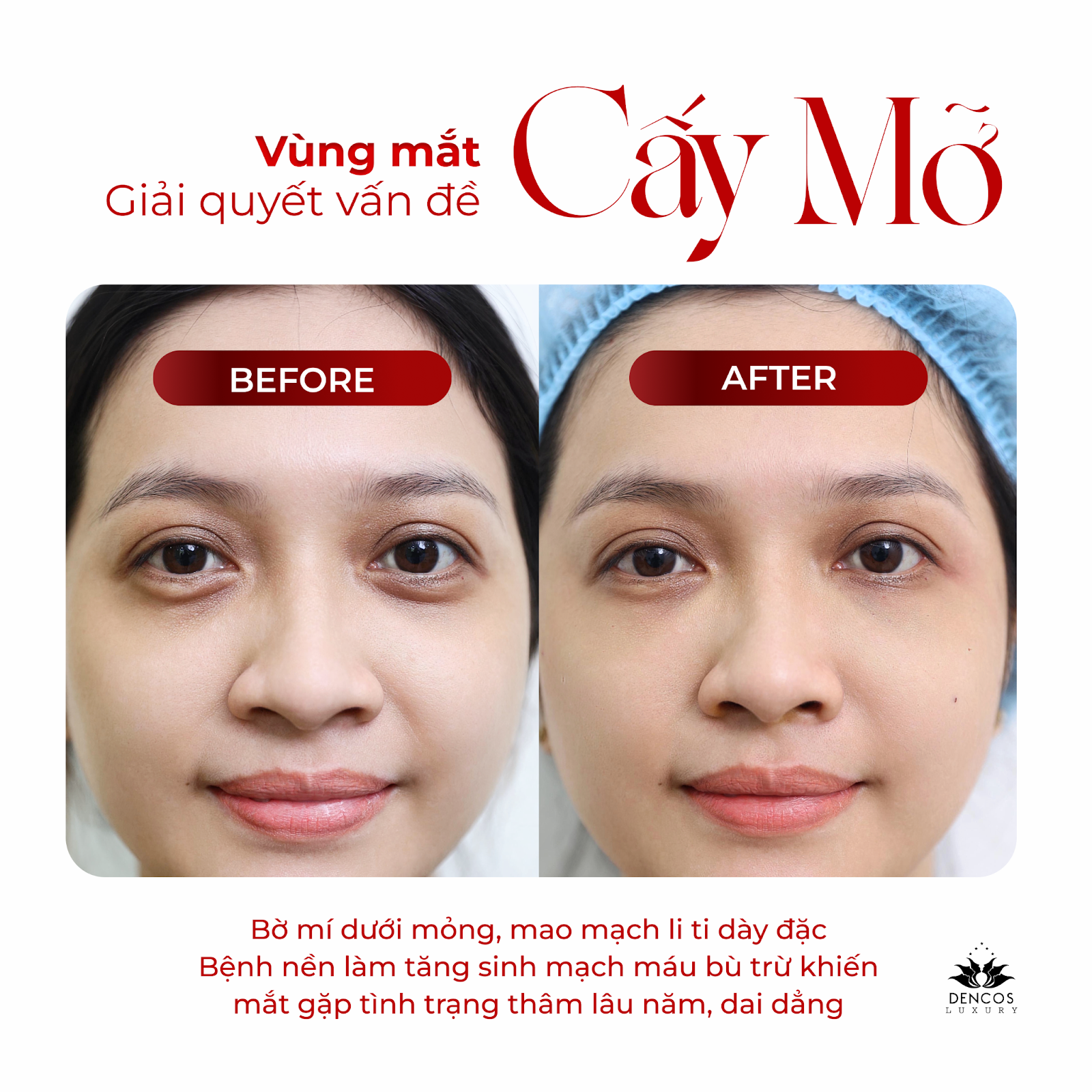 Cấy mỡ tự thân - Giải pháp xử lý triệt để trũng, hóp, mất cân đối gương mặt tại Dencos Luxury