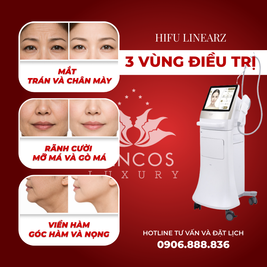 Hifu LinearZ - Nâng cơ, giảm mỡ đa tầng công nghệ cao tại Dencos Luxury