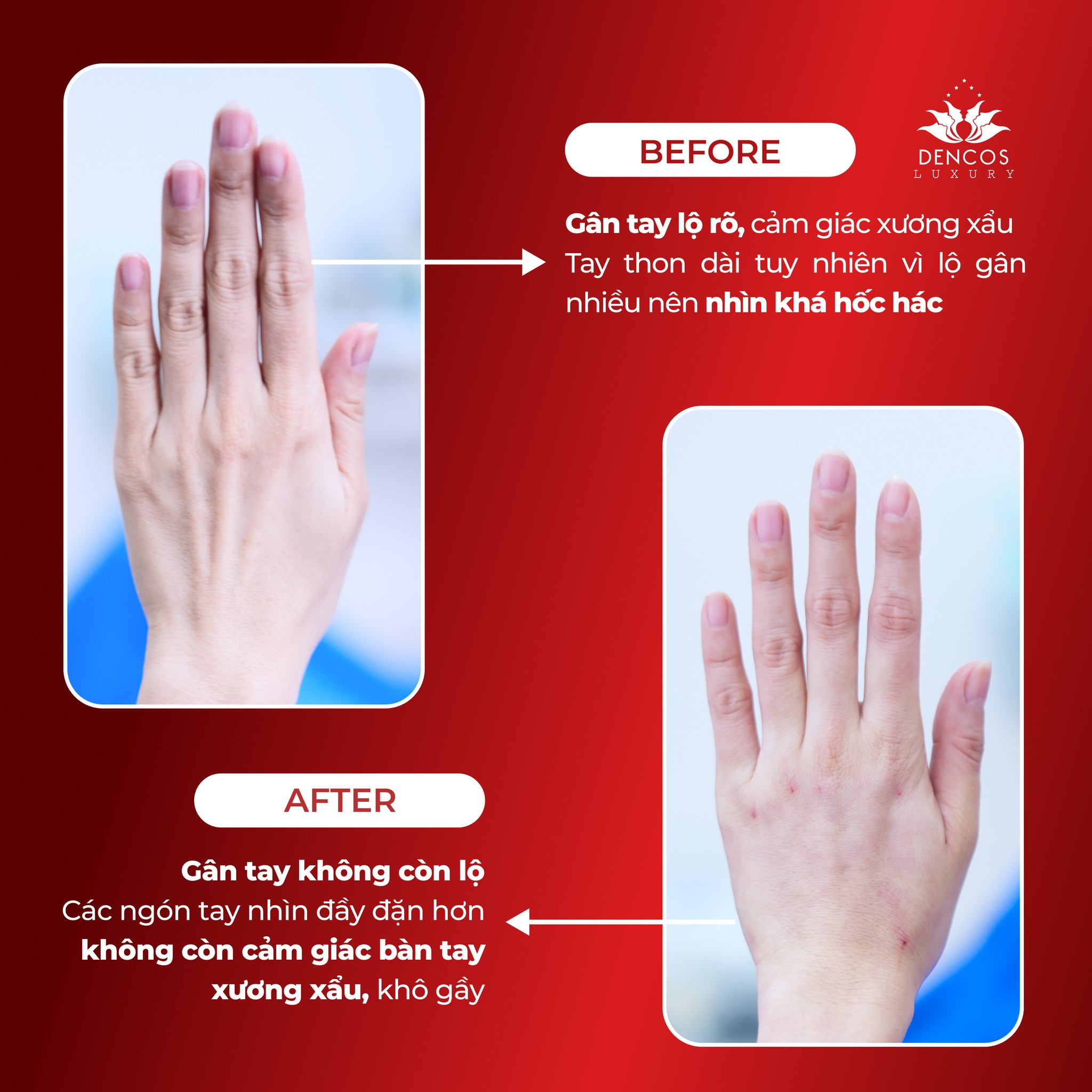 Vampire Handlift – Công nghệ tái sinh đôi tay “không tuổi”
