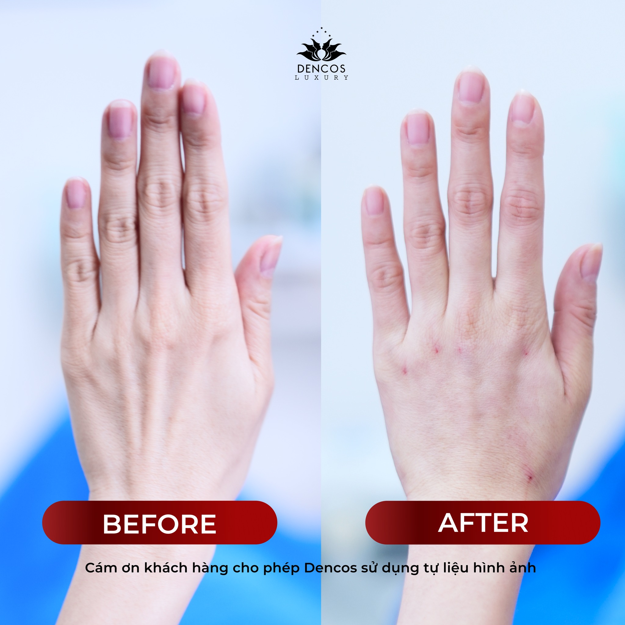 VAMPIRE HANDLIFT: ĐÁNH THỨC VẺ ĐẸP “BÚP MĂNG” – TỪ BIỆT ĐÔI TAY GẦY GUỘC, GÂN XANH