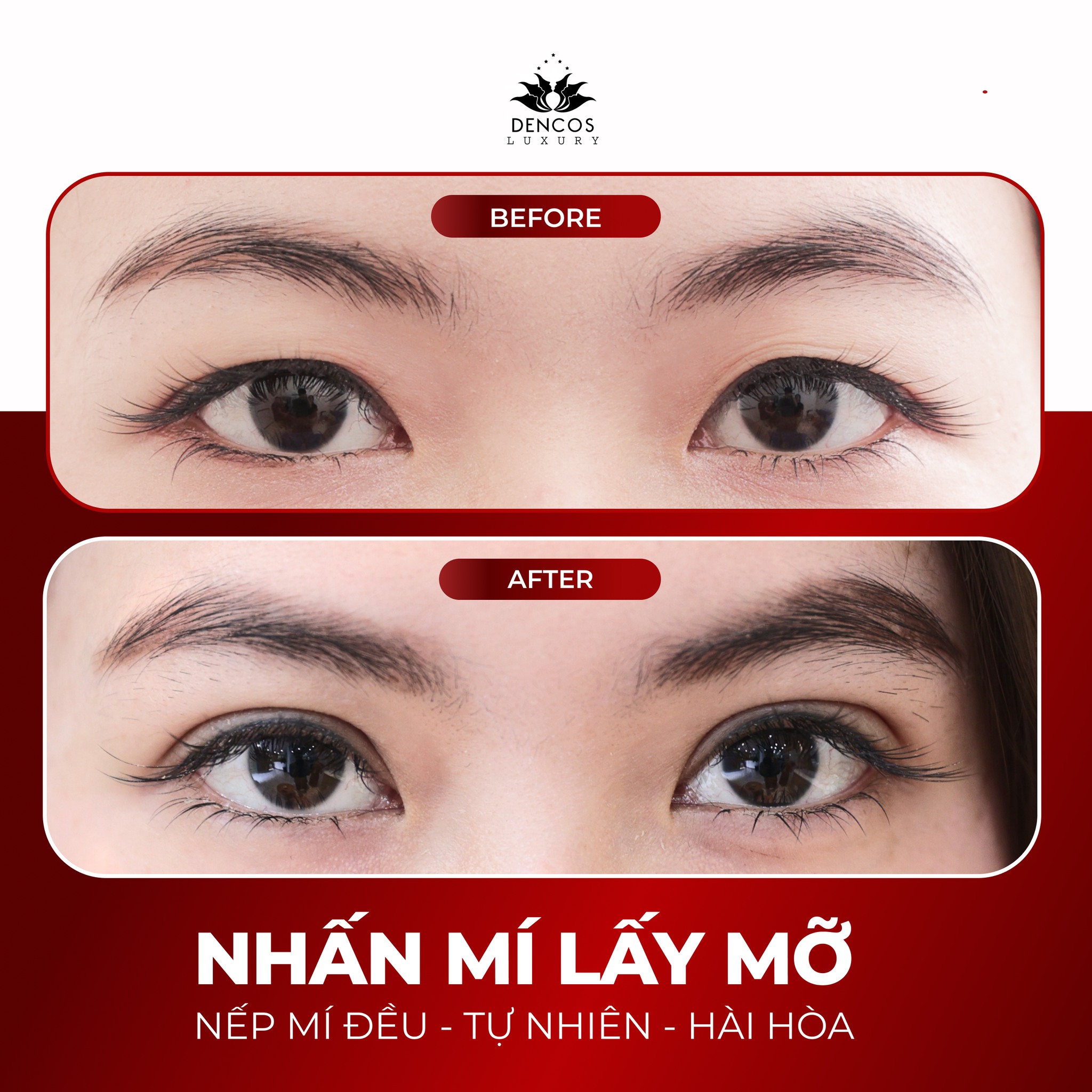CẮT MÍ & NHẤN MÍ TẠI DENCOS LUXURY: TÁI TẠO ÁNH NHÌN, KIẾN TẠO SỰ CÂN ĐỐI TỰ NHIÊN
