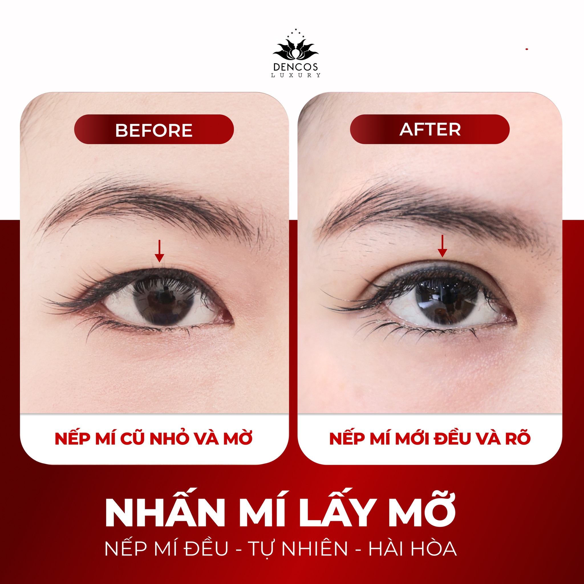 VÌ SAO NÊN THỰC HIỆN THẨM MỸ MẮT TẠI DENCOS LUXURY?