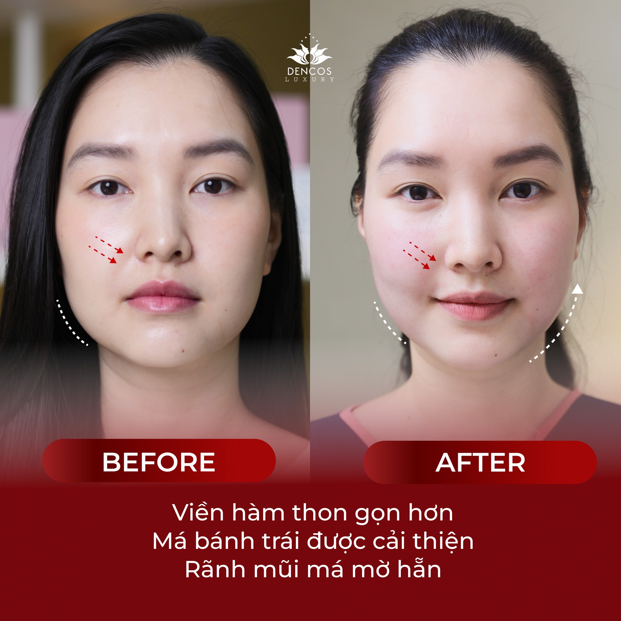 Tại sao Ultherapy Prime là lựa chọn của giới thượng lưu?