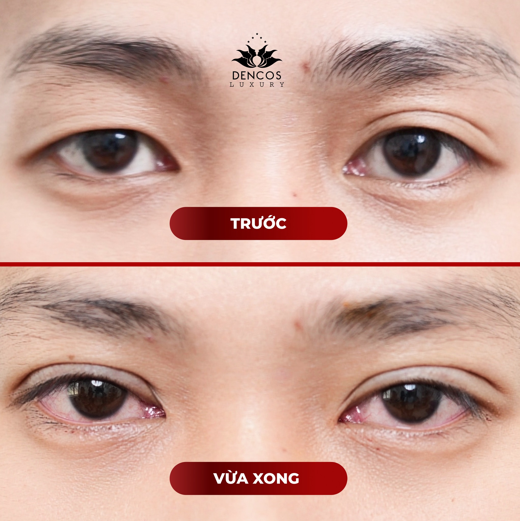 NHẤN MÍ: ĐIỀU CHỈNH MÍ BẨM SINH KHÔNG ĐỀU, TẠO HÌNH TỰ NHIÊN