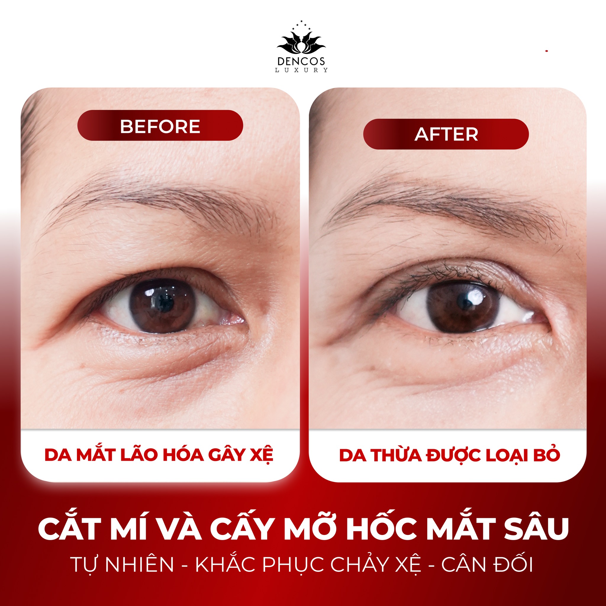 CẮT MÍ KẾT HỢP CẤY MỠ HỐC MẮT: PHỤC HỒI TOÀN DIỆN ĐÔI MẮT LÃO HÓA