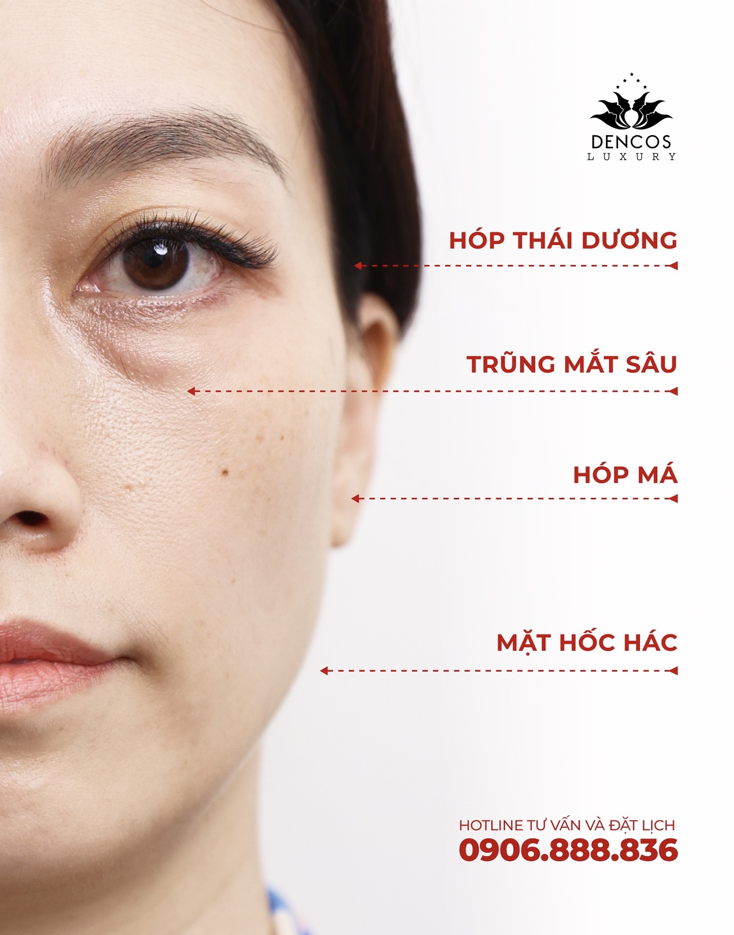 AMPIRE FACELIFT TẠI DENCOS LUXURY | LIỆU PHÁP TINH CHỈNH GƯƠNG MẶT TOÀN DIỆN