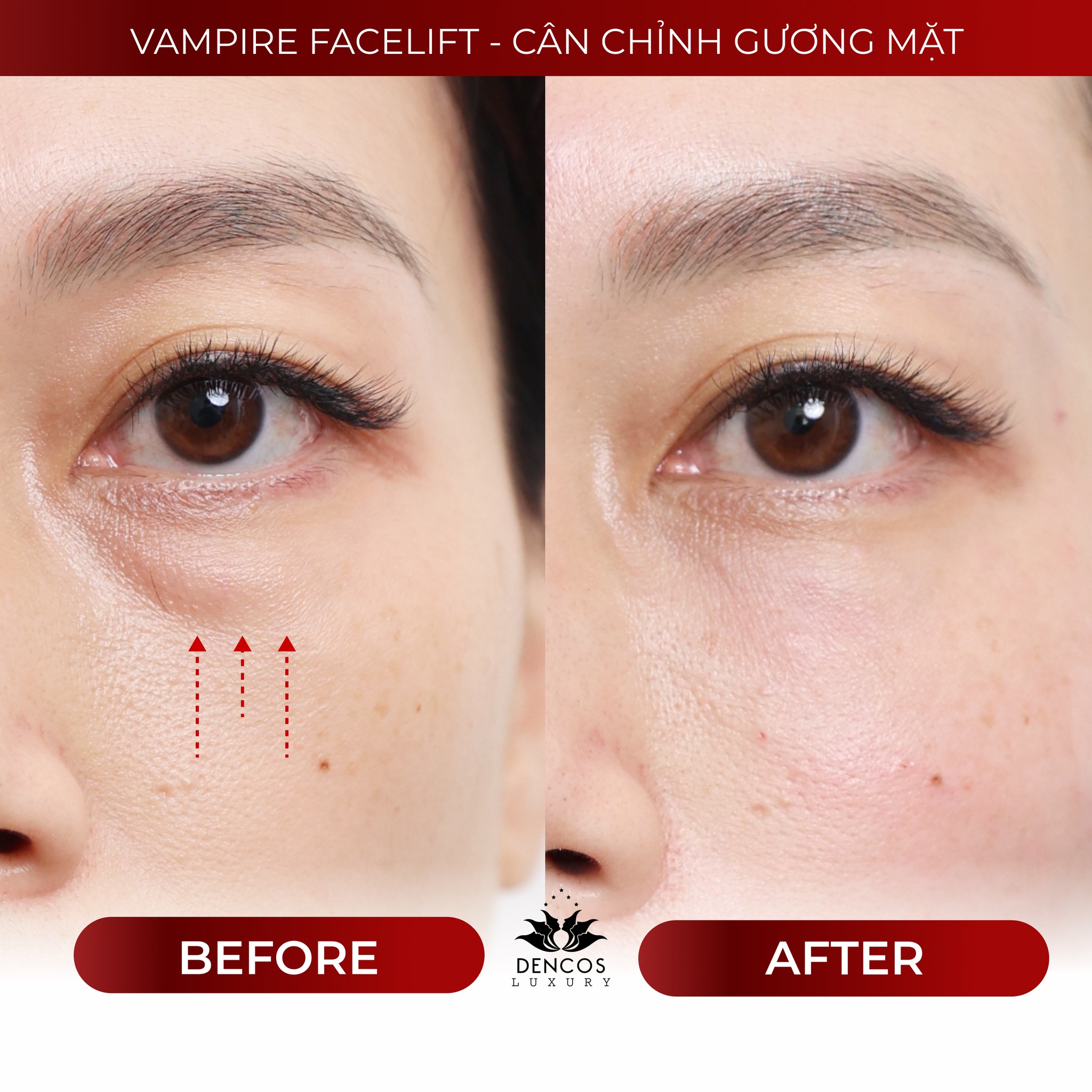 Cân chỉnh đường nét khuôn mặt