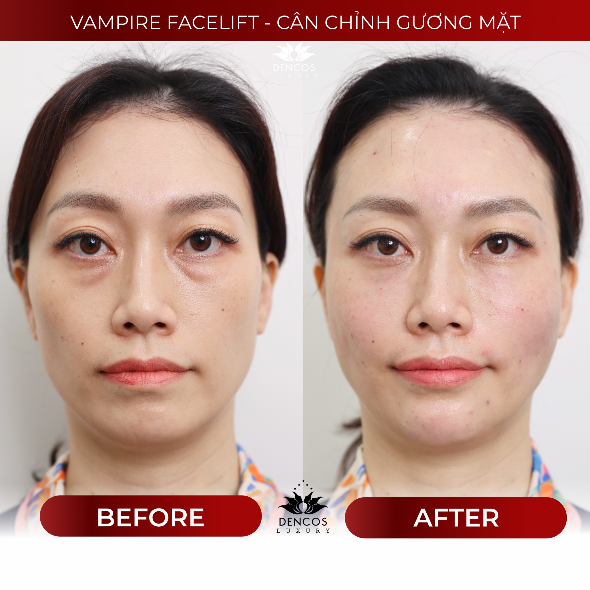 Vampire Facelift – Trẻ hoá da mặt