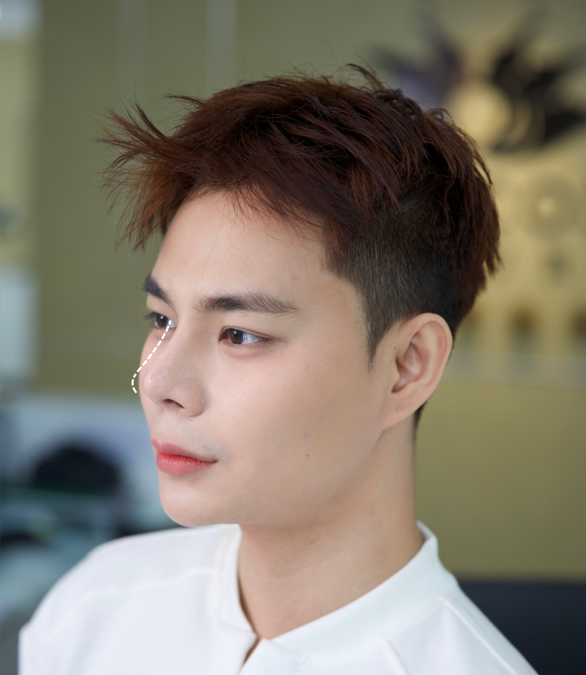 Thẩm mỹ mũi