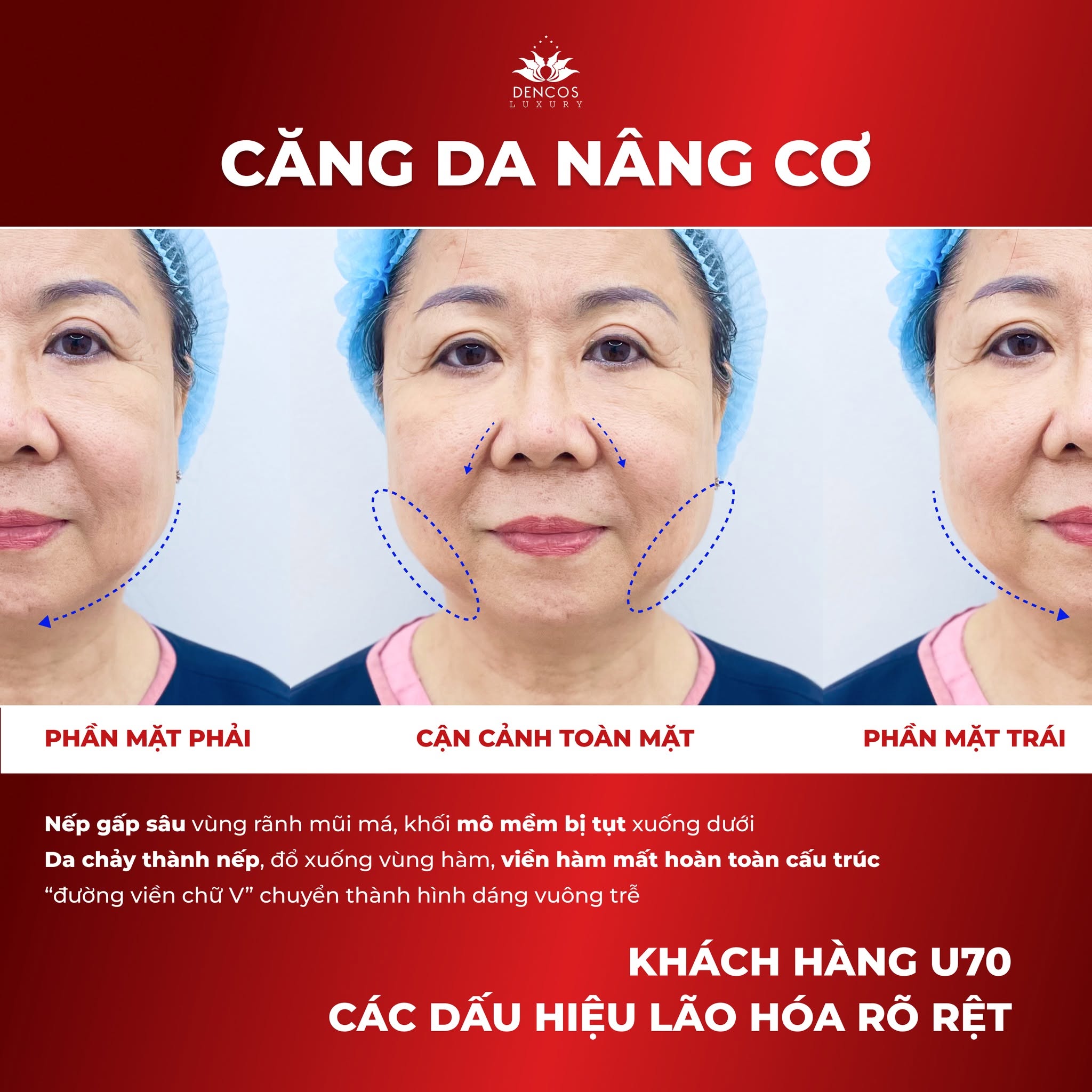 Căng da bằng chỉ sinh học không phẫu thuật