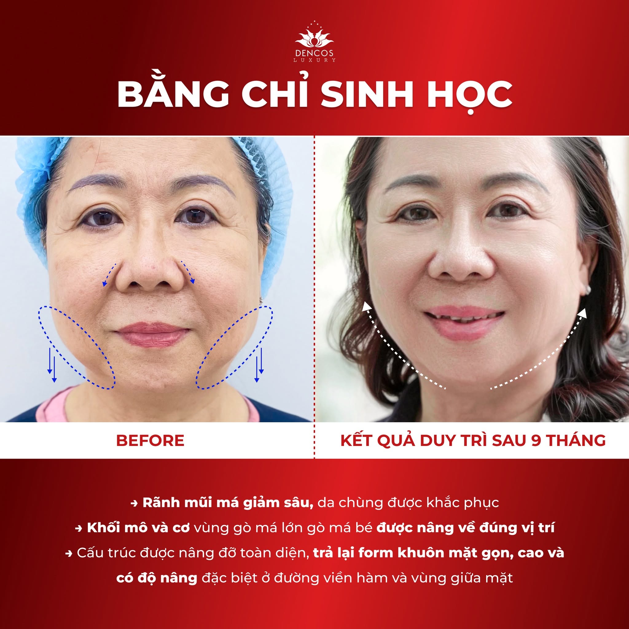 Căng da bằng chỉ sinh học không phẫu thuật