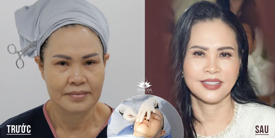 Căng da bằng chỉ sinh học không phẫu thuật