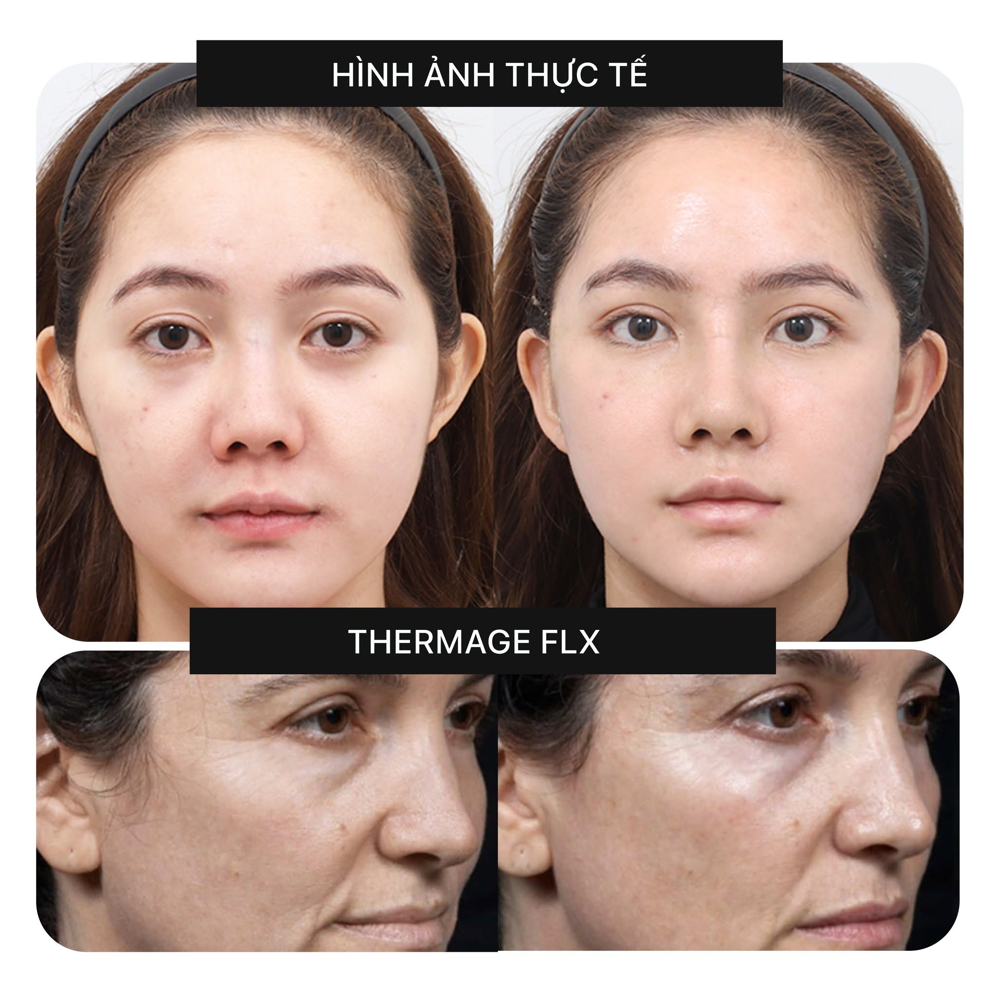 Chỉ 1 Lần Điều Trị Theramge FLX Tại Dencos Luxury – Hiệu Quả Kéo Dài 1 Đến 2 Năm