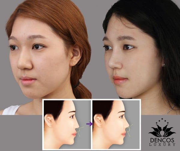 Mũi tiêm filler trước có thể đặt sụn lại dễ dàng, nhưng mũi đã đặt sụn trước lại gây khó khăn nếu muốn tiêm lại bằng filler.