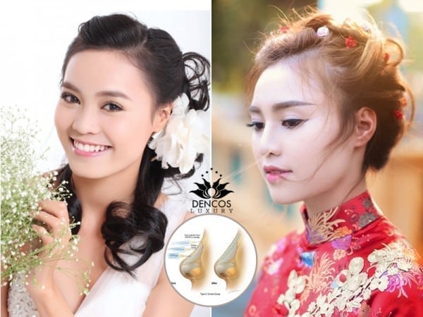 Ninh Dương Lan Ngọc và chiếc mũi S-line 3D đẹp hoàn hảo sau khi tiêm filler tại Dencos Luxury.