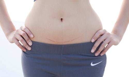 Hãy để tâm đến những vết sẹo.