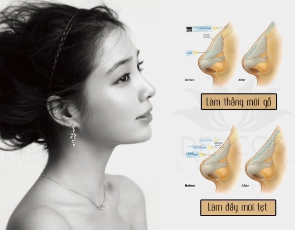 Filler thích hợp điều trị các dạng mũi thấp, mũi gồ hiệu quả.